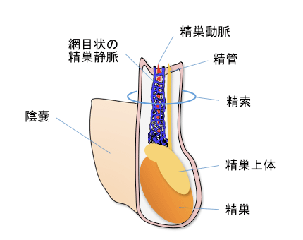 静脈 瘤 手術 精 索 精索静脈瘤の原因と日帰り手術－画像でみる精索静脈瘤の症状と男性不妊の治療