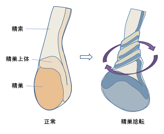 ねじれ 金玉