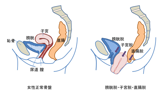 子宮 降り て くる