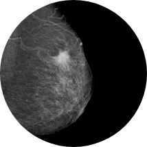 マンモグラフィ検査
